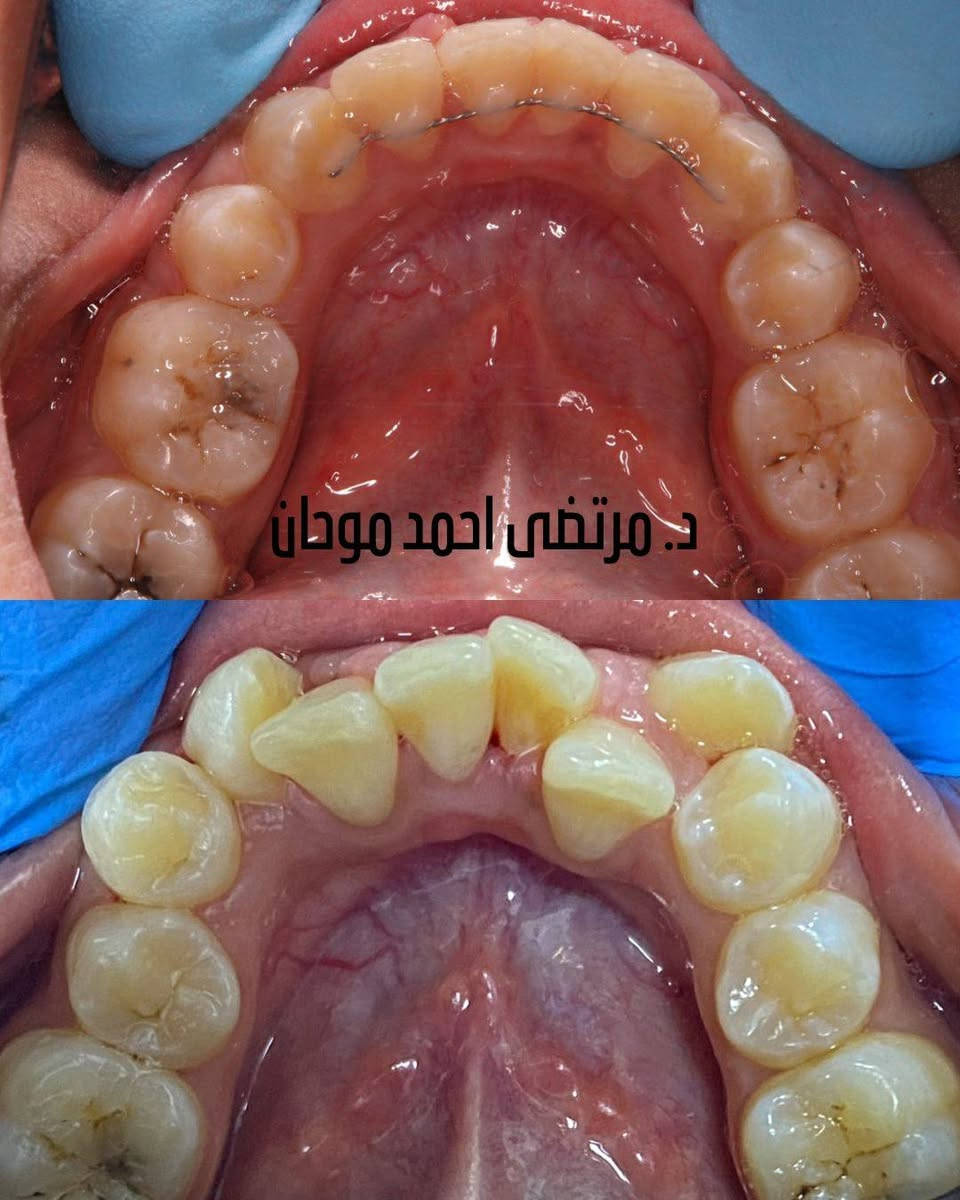 تعديل تراكب وتزاحم الاسنان بواسطة التقويم المعدني من شركة دنتارم تمت الحالة خلال سنة وشهرين فقط
الحمدالله حصلنا نتيجة ممتازة ومرضية للمراجعة
طبيب تقويم الأسنان مرتضى أحمد موحان
للحجز واتساب ***********
تكدر تزورنا ونفحص اسنانك تحتاج تقويم او لا
معاينةالتقويم مجاني
فرع شيخ صاحب مجمع علي تركي
الطابق الثاني
