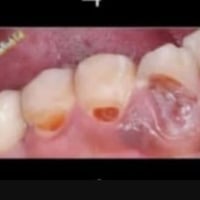 تسوس قرب اللثة • علاج مجاني • عيادات بيارق