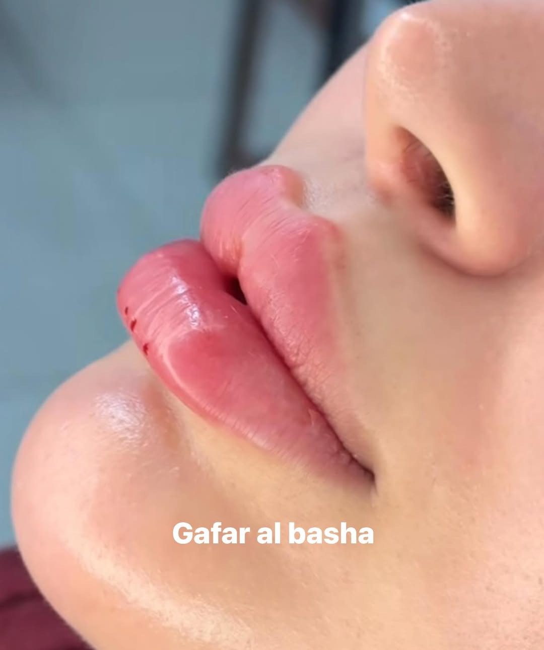 اكيد كيكاتنه منتظرات عروض اعيد الاضحى🌲🌲🌲
١-  الفرنسي واحد سيسي 75 بدل ال100
٢- البريطاني واحد سيسي اب 100 بدل ال125 الف
٣- السويسري واحد سيسي اب 75 بدل ال100
٤- سويسري واحد سيسي  ١٢٥
٤- كوري واحد سيسي 40 بدل ال50 
٦- كوري واحد سيسي اب 50 بدل ال75
٥- كوري للشفه فقط واحد سيسي 150 بدل ال175 الف
٦- سوفت فيلر للهالات اصلي اب 150 بدل ال200 الف 
بوتكس ابره وحده اب100  ابرتين ب125 الف  بدل ال150 الف 
تغيير شامل ب 400 بدل ال500  
تغيير شامل vip 600 بدل ال750 
ميسان مغربه للحجز مراسلتنا   
***********
***********
