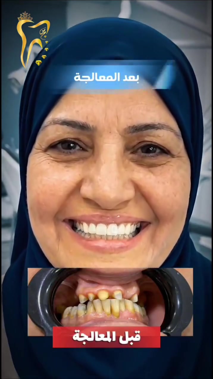 حلم الابتسامة المثالية صار قريب… وما راح يكسر الخاطر! 🦷✨

  بأحدث التقنيات، وبأقساط مريحة تناسب جميع  العوائل.

  سجل بياناتك هسه، وتبدّي تبتسم بدون تردد.

متواجدين لخدمتكم طيلة أيام الأسبوع 
العنوان بغداد المدائن شارع الاطباء مقابل مجمع البيت الاصفر 
***********
#تبييض_الاسنان #تقويم_اسنان #زراعة_الاسنان #صحة_الأسنان
