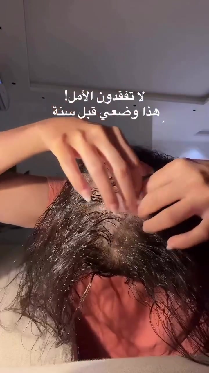 هذا وضع هواي زبونات قبل ليعرفون كورس الشعر المعالج من براند زهره ستور ، لكن بعد الإلتزام بكورس الشعر النتيجه ماشاءالله  💖.
ـــــــــــــــــــــــــــــــــــــــــــــــــ
للحجز والأستفسار دايركت 📩.
هـ: ***********

#اكسبلور #صحة #جمال #براند #زهره_ستور #شعر_صحي #تساقط_شعر #لايك #منشن #العراق #البصرة #مشاركة
@إشارة
