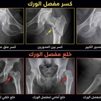 🩻 إصابات مفصل الورك... التشخيص الدقيق يبدأ بالأشعة الرقمية DR  📍 يُعد ...