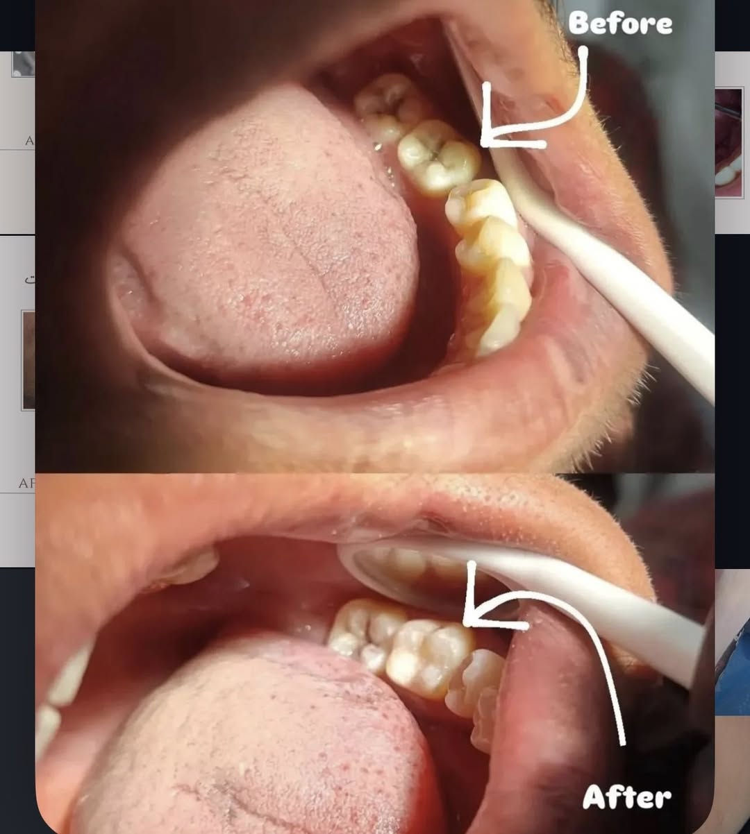 🦷 علاج أسنان مجاني 100%! لفترة محدودة ⏳

#حشوات تجميلية بجلسة واحدة  
#تنظيف اسنان | #قلع الاسنان والجذور التالفه | #تقويم اسنان   
#تعويض أسنان (فك كامل أو فكين)  
علاج مشاكل أسنان #الأطفال بالكامل👶  

👩‍⚕️ بإشراف أطباء اختصاص  ✨ أجهزة وتقنيات حديثة  

📍 #شارع 40 – مجاور صيدلية سلامتك أولاً  

📲 واتساب: ***********  

📸 الصور نماذج من شغلنا

