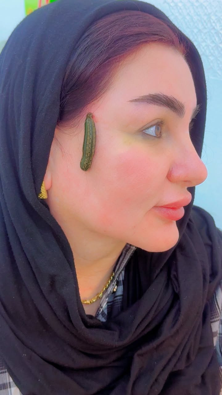 العلق الطبي لعلاج البشرة 
*********** واتساب
