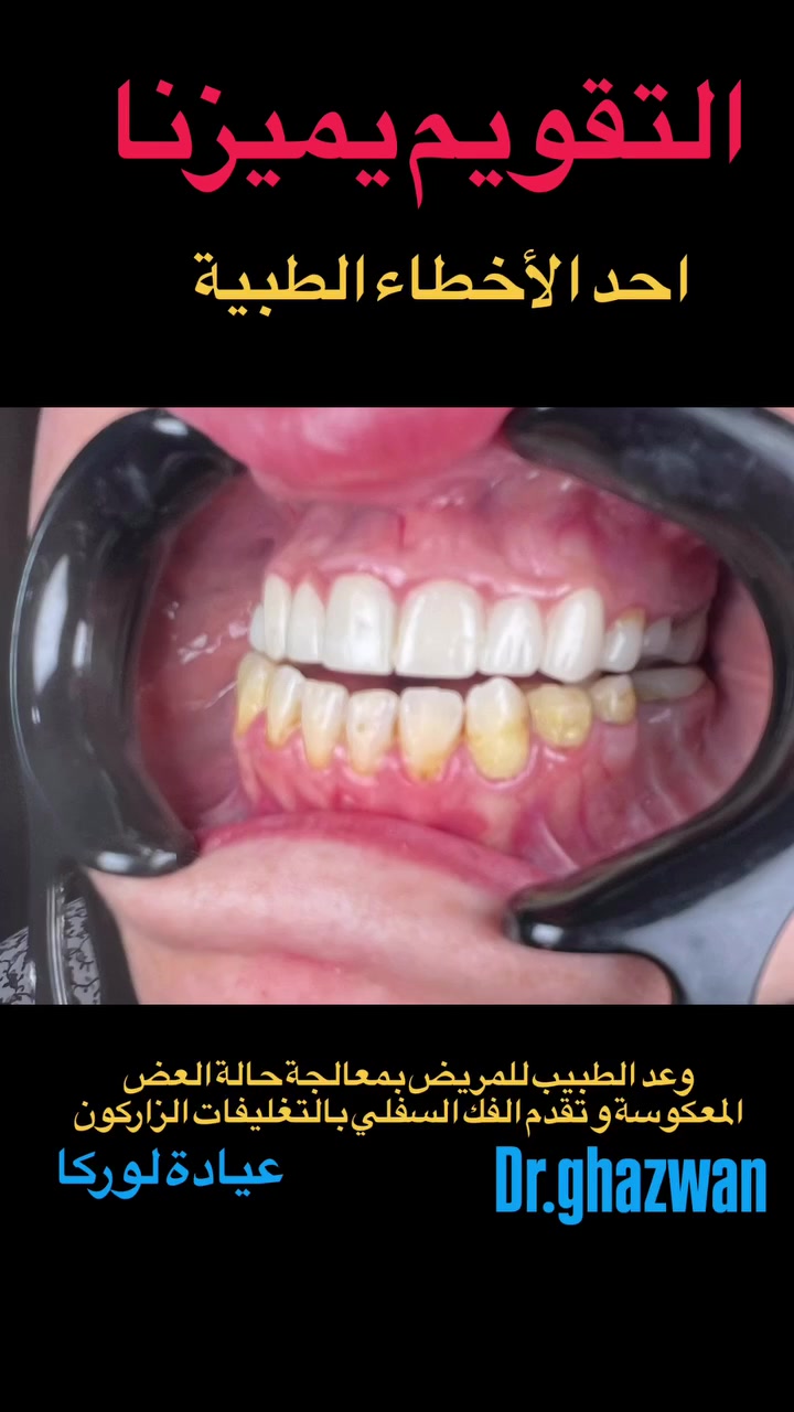 التقويم يميزنا احد الحالات تقدم الفك السفلي و فشل الطبيب السابق حيث وعد المريض من خلال التغليفات الزاركون يتم حل مشكلة تقدم الفك السفلي ( العضة المعكوسة) و النتيجة كانت أسوء مماكان عليه المريض و تعقدت الأمور نحو الاسوء يعاني المريض من المظهر الخارجي غير متناسق و عدم القدرة على تقطيع الطعام و الكلام و مخارج الحروف غير متناسقة و مشاكل اخرى و بعد تغليف الاسنان زادت الامور نحو الاسوء  حيث صعوبة وضع جهاز تقويم العظم و صعوبة التحكم …. علاج جميع الحالات الصعبة و المستعصية نتائج مضمونة بخبرة علمية متمكنة للحالات المعقدة جمالية فائقة بخطوات طبية مدروسة اسعار مناسبة بالتقسيط المريح… دكتور غزوان مزهر بغداد الكرخ نفق الشرطة بداية شارع الاطباء عيادة لوركا فوق صيدلية كنز النفق متوفر واتس *********** #تقويم_الأسنان_والفكين #تقويمالأسنان #تقويم_الأسنان_بأنواعه #تقويم_الشفاف_للأسنان #تقويم_الأسنان_قبل_وبعد @تقويم_الاسنان @تقدم_الفك_السفلي @العضة_المعكوسة @العضة_المفتوحة @العضة_العميقة @تزاحم_الاسنان
