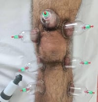 حجامة نسائية • ركبة • طويريج