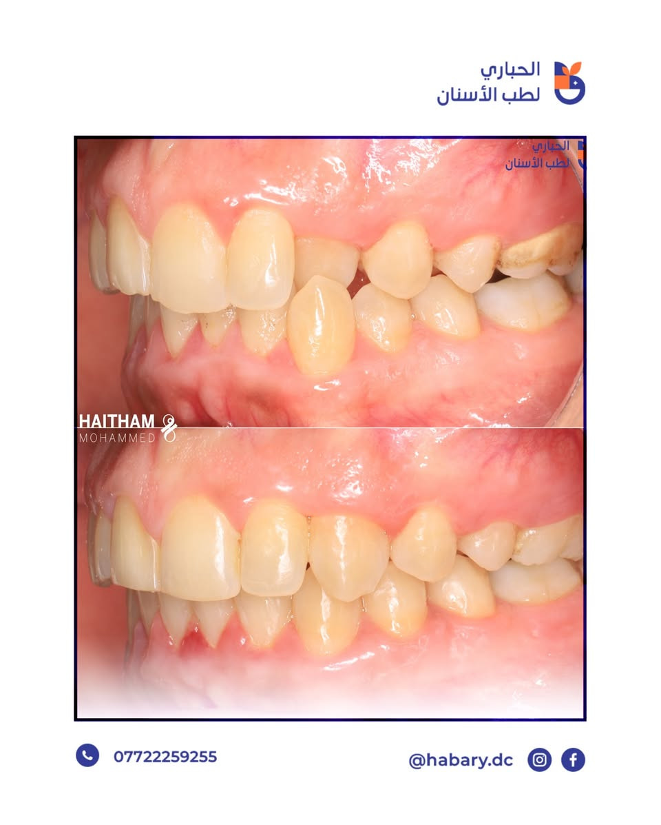علاج العضة العميقة و تعديل إبتسامة مراجعة بتقويم الأسنان✨
المسيب - مجاور مركز صحي المسيب - مقابل مول فاملي المسيب- فوق مطعم سوبر صوص. 

رقم الحجز : ***********
