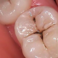 منو عنده من هاي الحالة تسوس بسيط بالأسنان الخلفية ويكون العلاج مجاني و...