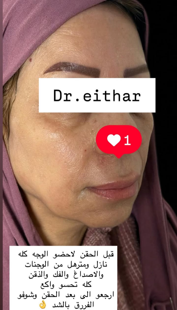 التغيير والشد والشفة ولاغلطة 🔥🔥🔥
استداره وجه كامله بطريقه الشد ولفتتك 🔥رفع وجنات والاصداغ وتدوير الفك والذقن✨وفلر  الشفة

بلشت عروووووض عيد الحب نزلتهه الكم بالستوري بالهايلايت وببوست اعلى الصفحة تبلش من باجر الخميس ✨
 
د.ايثار سامي عبد الامير
الكوت الهوره مجمع القبطان طابق اول قرب كوزمتك احمد باريس
الحجز***********
