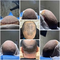 المركز الاول في بغداد لزراعه الشعر  بشهاده الزبائن والنتائج خلال ٨ سنو...