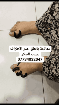 العنوان محافظة واسط قضاء النعمانية شارع 13
#دودة العلق : أمل جديد لمرضى السكري في إنقاذ الأطراف من البتر!

يعاني الكثير من مرضى السكري من تقرحات القدم ومشاكل الدورة الدموية التي قد تؤدي في بعض الحالات إلى البتر. لكن هل تعلم أن العلاج #بالعلق يمكن أن يكون حلاً فعالاً لإنقاذ الساق من هذه المضاعفات؟

🔹 كيف يعمل العلق الطبي؟

يقوم العلق بإفراز إنزيمات تساعد على تنشيط الدورة الدموية في المنطقة المصابة.

يفرز مضادات تخثر تمنع انسداد الأوعية الدموية وتعزز تدفق الدم.

يمتلك خصائص مضادة للالتهابات، مما يسرّع شفاء الجروح والتقرحات.

يساعد على تخليص الأنسجة من السموم، مما يقلل خطر العدوى ويحسن قدرة الجسم على التجدد.

✅ النتيجة:

تقليل الالتهابات والتقرحات.

تحسين تدفق الدم في الساق.

تسريع التئام الجروح ومنع تفاقمها.

تقليل الحاجة إلى عمليات البتر بفضل تحفيز تجديد الأنسجة.

إذا كنت أو أحد معارفك يعاني من مشاكل القدم السكرية، فقد يكون العلاج #بالعلق هو الحل الطبيعي الفعّال لإنقاذ الساق وتحسين جودة الحياة.

للاستفسار والحجز، يمكنكم التواصل معنا!
***********
#العنوان  
النعمانيه _شارع 13

#الحجامة_للنساء
#الحجامة_النسائية
#فوائد_الحجامة
#صحة_المرأة
#العلاج_النبوي
#الطب_البديل
#الطب_التكميلي
#حجامة
#حجامة_العراق
#حجامة_واسط
#حجامة_بغداد
#حجامة_كربلاء
#حجامة_النجف
#تنشيط_الدورة_الدموية
#تفريغ_السموم
#آلام_الظهر
#آلام_المفاصل
#الصداع
#الراحة_والاسترخاء
#عناية_بالجسم
#صحة_وجمال

#الجميع #اشارة #متابعين @إشارة
