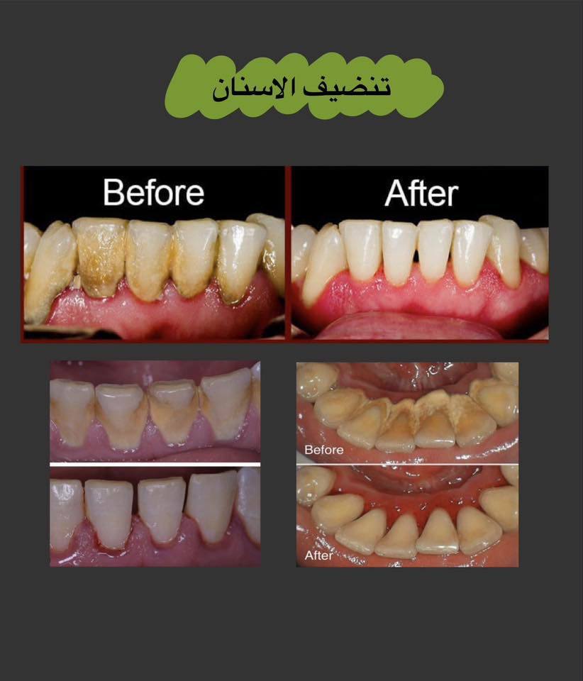 📍عيادات ابن سينا التخصصية-مقابل محطة وقود البياع
📝للحجز والاستفسار:
.مراسلة الصفحة
.واتساب ***********
✨علماً ان العلاج مجاني بالكامل
