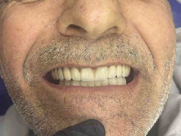 عيادة الدكتورة زهراء الحيدري لطب وتجميل الاسنان

زراعة الاسنان يمنا غير   

انظمة دفع مريحة 💵 

جودة عالية💪 

حلول خاصة لمرضى السكر او ضعف العظام 🦷🪥 

للحجز والاستفسار 

***********

صفحة العيادة 

https://www.instagram.com/dr.zahraalhaidari?igsh=MTNjazNxa3czdnVtbw== Colombo
