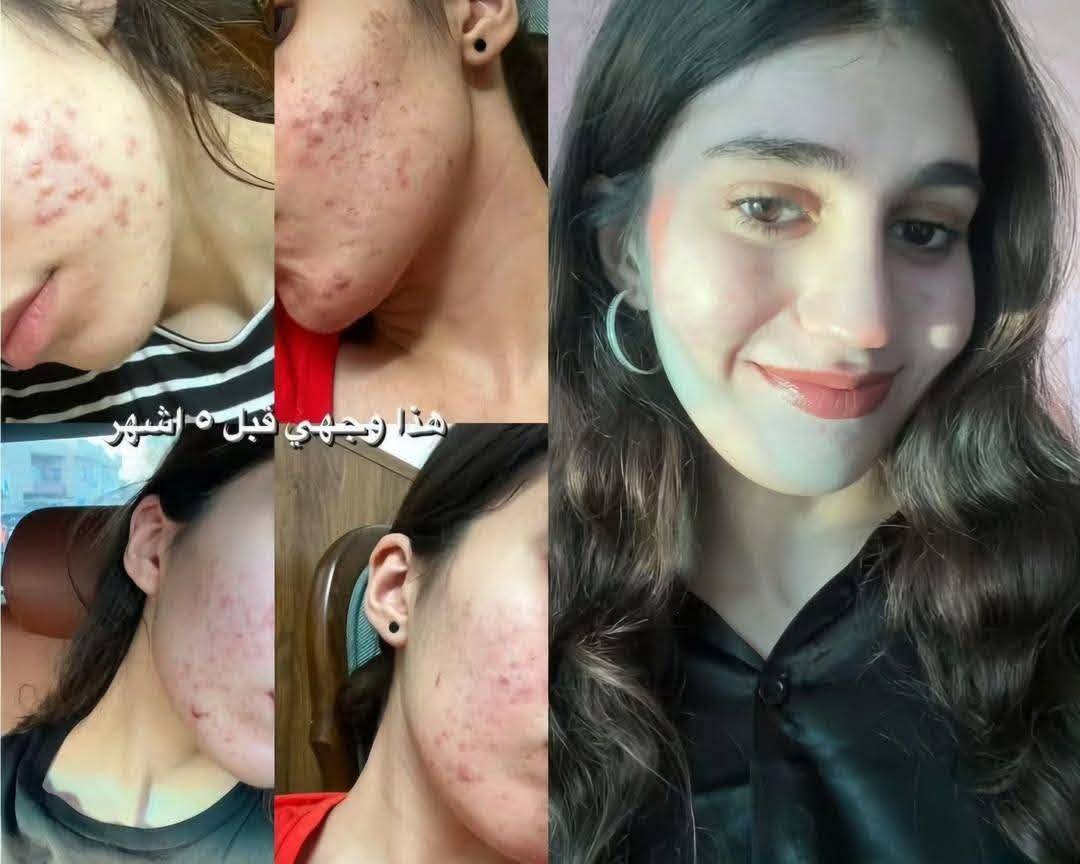 هلاوووو حبيباتي ❤️
رجعت توفرت تركيبة علاج الحبوب واثارها💯👍
للاستفسار دايركت
الجميع


**إذا كنت صاحب هذا الإعلان وتريد حذفه لأي سبب، رجاءا أرسل رسالة إلى الدعم الفني**