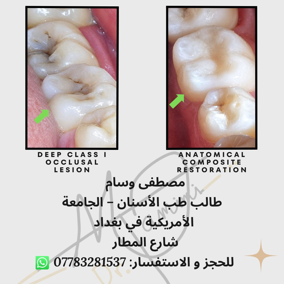 🦷 فرصة علاج الأسنان في عيادات الجامعة الأمريكية في بغداد
العلاج يتم تحت إشراف أطباء اختصاص وضمن نظام تشخيص أكاديمي دقيق.
✔️ حشوات تجميلية
✔️ تنظيف أسنان
✔️ علاج جذور
✔️ تراكيب سنية
✔️ فحص وتشخيص كامل
💰 العلاج مجاني
📍 الموقع: الجامعة الأمريكية في بغداد – شارع المطار
📞 للحجز والاستفسار (واتساب): ***********
⚠️ الإعلان لغرض تنسيق المواعيد ولا يمثل جهة رسمية تابعة للجامعة.
صور الجامعة من auib_shine

