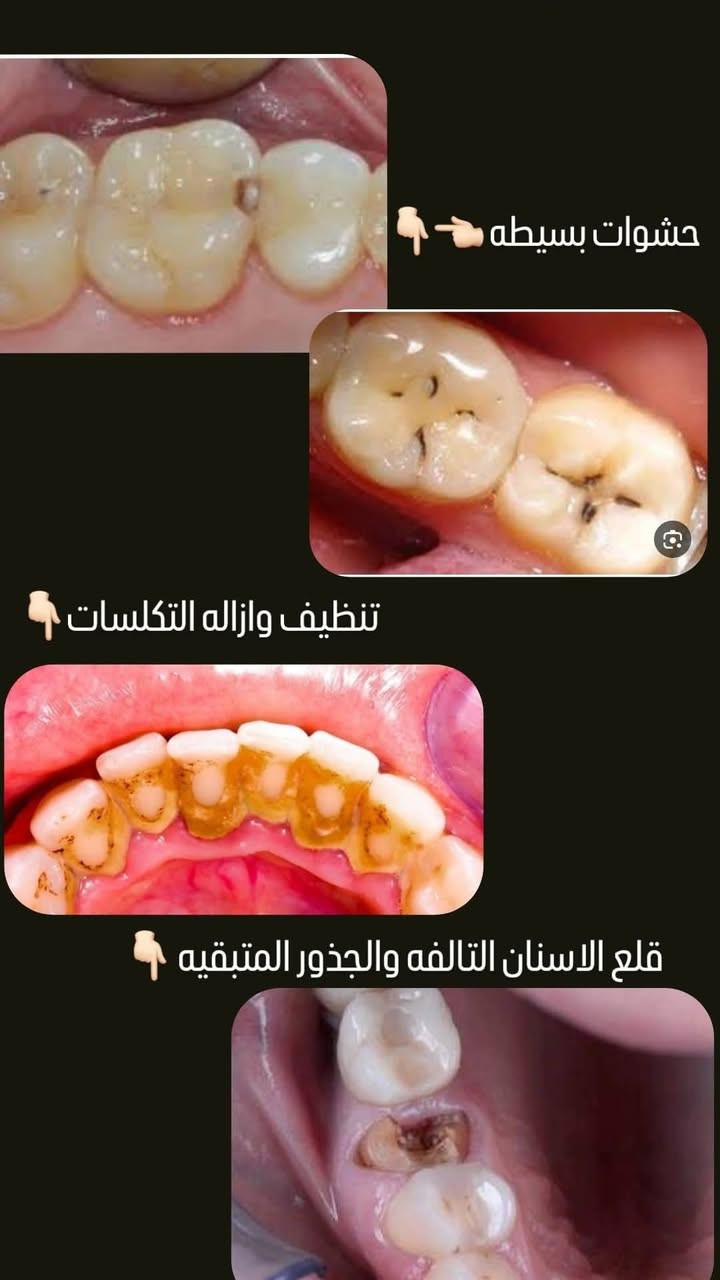 � خدمات أسنان متوفرة مجانًا
• قلع، حشوات، تنظيف الأسنان
 • تحت إشراف أطباء مختصين مجانًا�📍 الموقع: عيادات الكفيل، شارع الإسكان، قرب مستشفى الزهراء�👨‍⚕️ الدكتور: يوسف حسن توفيق�💬 لأي شخص يحتاج قلع، تنظيف أو حشوات، يمكنه مراسلتي مباشرة
***********
