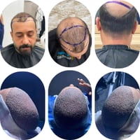 زراعة شعر • مانحة ضعيفة • بغداد المنصور