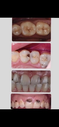 تسوس أسنان • حشوة مجانية • علاج أسنان