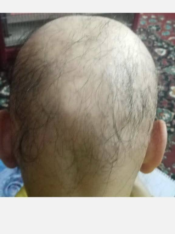 علاج حلات داء الثعلبه الشديده والصعبه في العياده التخصصيه للامراض الجلدية والتجميل الخاصه باستشاري الأمراض الجلدية
الدكتور شامل محمود الجبوري..
موصل جانب الايسر /تقاطع الجسر الرابع /مجاور مديرية بلديات نينوى /مجاور الجشعمي للاثاث /مقابل مرطبات ازبري
(مجمع الأمل الطبي 🏥)
للتواصل و الاستفسار :
***********
***********
***********
