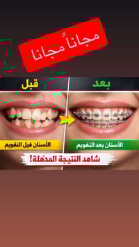علاج تقويم اسنان ‼️‼️مجاناً مجانا فقط لاعمار 10 الى 20 سنة مراسلت الصف...