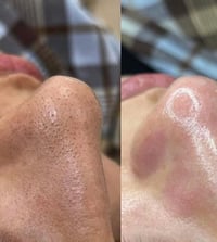 كوت زويريجات • فايبروز • هايدروفيشل