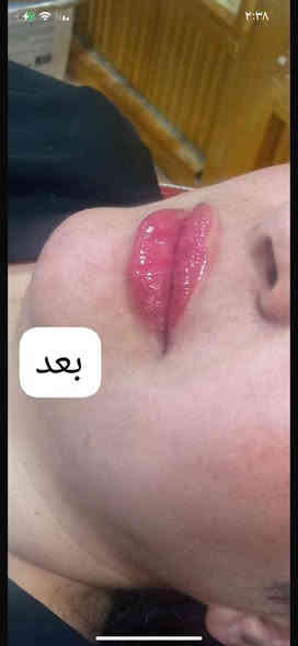 ارقى العروض من مركز لمسات  🫰❤️
عرض لمده اسبووووووعً🌺

هذا البيج مركز لمسات 

عرض التغيير الشامل ب٢٠٠ الفلر كوري  مع ابرة نضاره هديه♥️🥰

ب٢٥٠ مع البوتوكس الف بالفلر الفرنسي مع البوتوكس عرض ميتعوض فقط لحد  راس السنه♥️

فلر كوري السيسي ب٢٥ الف  للوجنات للشفه ب٣٠ 🌺

فلر امريكي ب٤٠ الف السيسي للوجنات للشفه ب٥٠  الف السيسي 🌺

فلر فرنسي ب٥٠ الف السيسي 
للوجنات و٦٠ الف للشفه 🥰😍
تغيير شامل يشمل البوتوكس بالفلر الكوري٢٠٠ الف يشمل بوتوكس وبدون بوتوكس ب١٥٠ الف مع جلسه نضاره وتنظيف وره اسبوع مجاني ♥️💐😍
عروض البوتوكس 
وجه كامل ٥٥ ♥️🥰

عين وجيبن ب٤٠ الف كل ثنين ب٧٥ عيون وجبين وجه كامل ١٠٠ للصديقات سوا ♥️

عرووض اليزر فل بدي ب٧٥ الف مع الظهر والبطن 💖
بكيني واندرام ثنينهن ب٢٥ 🌺

ساق كامله ب١٥ ايد كامله ب١٥ 😊
وجه ب١٠ رقبه ب١٠ 👌
مسح الاوشام  والتاتو الجلسه ب١٠ 🌺

ليزر كاربوني الجلسه ب١٠ 🌺

عروض البلازمه المفعله بالعمبر ب٢٥ الف الجلسه 💖💐
فقط بلازمه مفعله ب١٠ الجلسه 😊♥️

عرووض الميزوات جميع انواع الميزوات وابر النضاره الجلسه ب٢٥ 😍🌺

جميع العرووض تشمل تنظيف بشره ♥️🌺♥️💖مجاني مع كل جلسه وتدددلون علينه 🥰

للاستفسار الاتصال واتساب ***********
