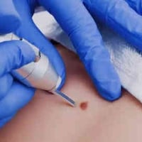 إزالة زوائد • خصوصية تامة • شارع الخليج