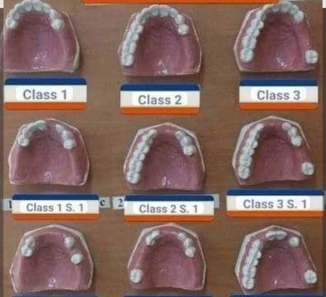 سلام عليكم
طالبة طب أسنان مرحله رابعه
اللي عنده هيك حاله او احد من اقربائه ويريد يسويله تعويض يراسلني واتس ***********
