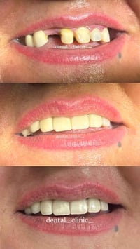 تركيبات زيركون • النعمانية • واسط