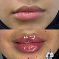 فلر شفة ١ سيسي  يدوم سنة طراوة عالية  للحجز على رقم الواتساب فقط ٠٧٧٣٣...