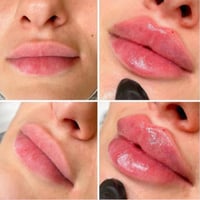 حقن فلر وجه وشفه فلر الكوري حقن السيسي    50 الف  وبلازما مفعله 10 الف...