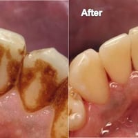 لمن لديه حالات مشابه لهذه الحالة يتوفر لدينا تنظيف اسنان مجاني للحجز ا...