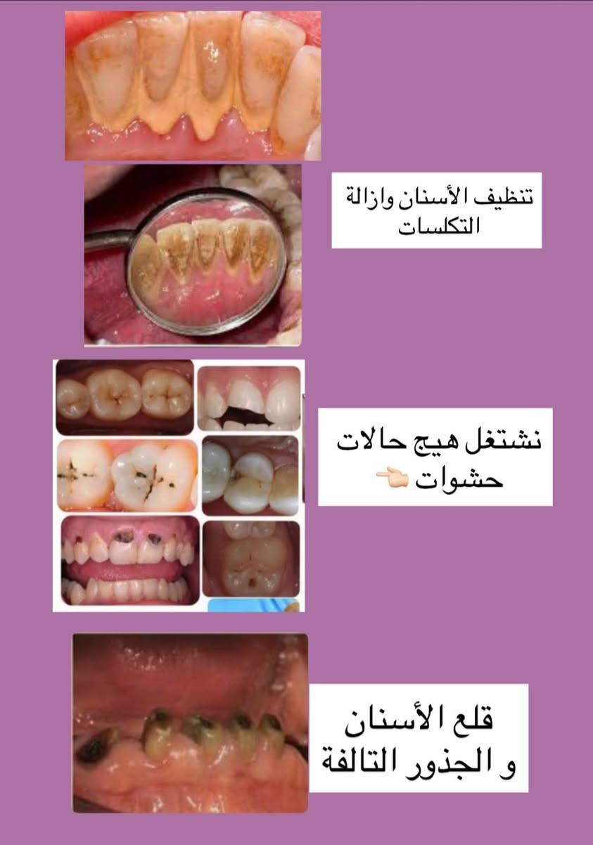 � خدمات أسنان متوفرة مجانًا
• قلع، حشوات، تنظيف الأسنان
 • تحت إشراف أطباء مختصين مجانًا�📍 الموقع: عيادات الكفيل، شارع الإسكان، قرب مستشفى الزهراء�👨‍⚕️ الدكتور: يوسف حسن توفيق�💬 لأي شخص يحتاج قلع، تنظيف أو حشوات، يمكنه مراسلتي مباشرة
***********
