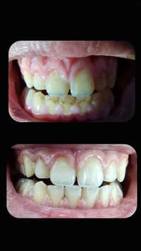 علاج اسنان مجاني • حشوات ضوئية • النجف الأشرف
