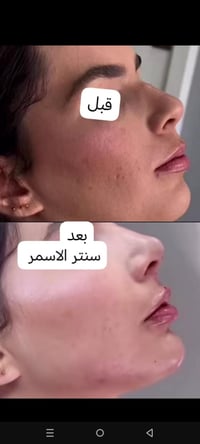 فلر ارداف نوع فرنسي كل ١٠٠ سيسي ب٤٠٠ الف للحجز والاستفسار ٠٧٧٢٨٩٨٢٥٨٥