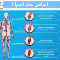 💚اعراض تخثر الدم!!! ❤أعراض تخثّر الدم:  قد يحدث تخثّر الدّم، أو ما يُع...