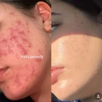 حبوب الشباب • كورس تراست • متابعة طبية