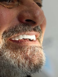 حالة زراعة فك كامل بزرعات فورية وتلبيس الاسنان الزاركون العنوان : المن...