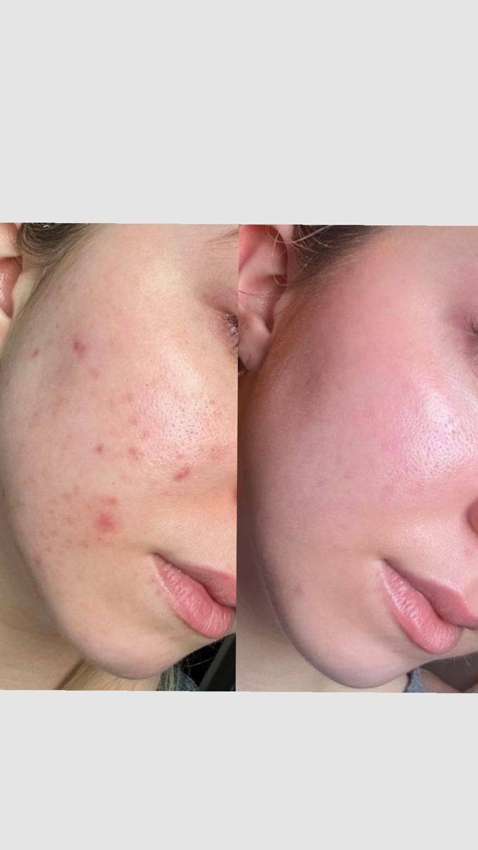 كريم تبيض نضاره للبشره
تتفتيح البشرة
حب شباب كلف نمش تصبغات
 ستخدم رجل نساء


**إذا كنت صاحب هذا الإعلان وتريد حذفه لأي سبب، رجاءا أرسل رسالة إلى الدعم الفني**