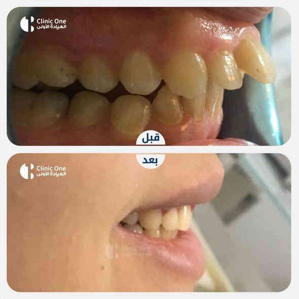 ((العلاج مجاني)) عيادات الجامعة الاسلامية لطب الاسنان
قلع الاسنان 
تنضيف الاسنان 
حشوات دائمية 
حشوات الاطفال 
طقم اسنان 
تقويم الاسنان 
للاستفسار مراسلتنا على الواتساب ***********
العنوان الميدينة القديمة مقابل عمارة الجيلاوي
