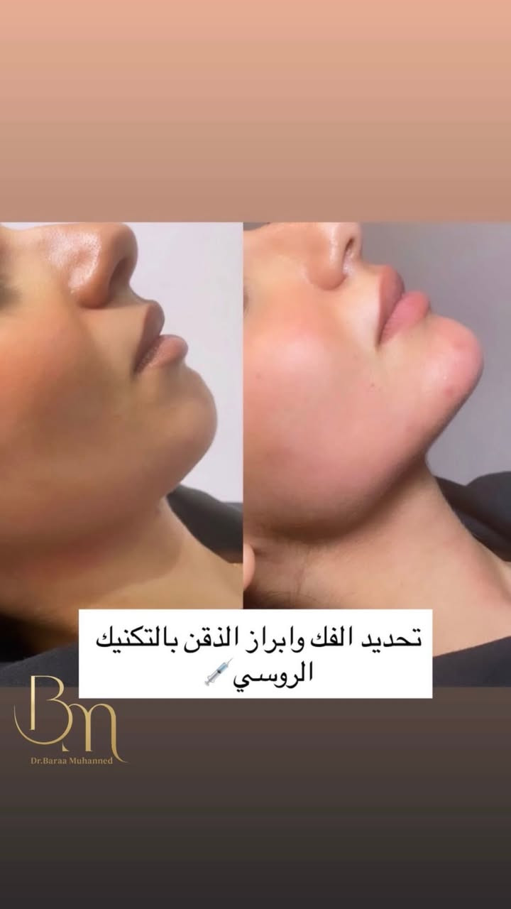 مع كثرة عيادات التجميل تتميز الدكتورة براء السوداني بنظافة وجمال الشغل عنوان العيادة شارع الاطباء قرب السوق الصغير مجاور مركز السفير داخل عيادة فيروز 
للحجز السريع او الاستفسار واتساب ***********
