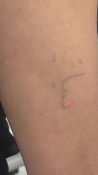 في عيادة فور يو ازالة التاتو بالليزر مو بس ازالة، هي امان وثقة. اذا كن...