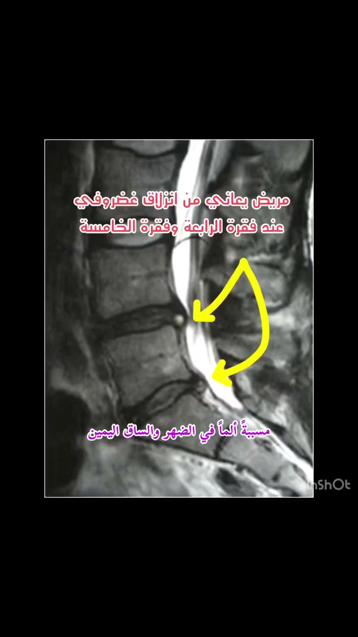 يتـواجد غداً الاربعاء #الدكتور مكرم نور الدين اخصائي طب الدماغ والاعصاب والفقرات 
#الانزلاق الغضروفي
#الدكتور مكرم نور الدين
#اخصائي جراحة الدماغ والفقرات  
 مريضنا يعاني من حدوث انزلاق غضروفي شديد مسببةً ألم شديد بالظهر ومريض لا يرغب في اجراء عملية فتح الفقرات فقمنا له بإجراء حقن قسطاري للفقرة القطنية الخامسة . 
#مجمع الكندي الطبي الحويجة ☎️***********☎️
عيادة دكتور مكرم نورالدين مسرهد جراحة الدماغ والفقرات
