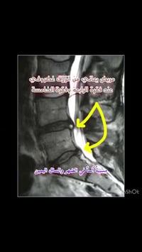 د. مكرم نور الدين • انزلاق غضروفي • حقن قسطاري