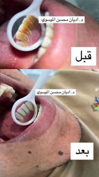 تكلسات • حلة شارع ٤٠ • صيدلية سلامتك