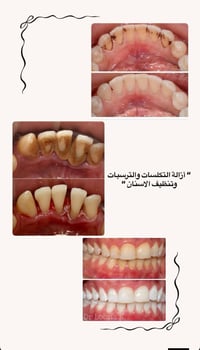 تنظيف أسنان • علاج مجاني
