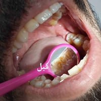 🦷 قبل وبعد تنظيف الأسنان وإزالة التكلسات   إحدى الحالات التي تم العمل ...