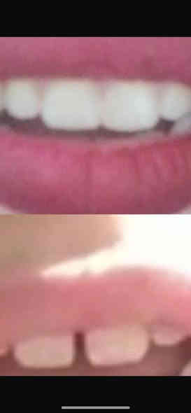 الى الاهالي الكرام ♥️

نود اعلامكم عن افتتاح عيادة طب وجراحة الاسنان
داخل مجمع الزيتون الطبي 

الدكتورة/سميرة مهدي جاسم 
-تنظيف وتبييض الاسنان 
-قلع الاسنان
-حشوات عادية وتجميلية وجذور 
-جسور المتحركة والدائمية 
-علاج اسنان الاطفال 

حسب الاوقات التالية :من الساعة الرابعه عصراً وحتى الثامنة مساءاً (٤-٨)
موقع العيادة:مجمع الزيتون الطبي /هور رجب مقابل افران الزيتون 
للاستفسار الاتصال على الهاتف ***********

(ابتسامتك هي سر جمالك) 

تنورونا ♥️
