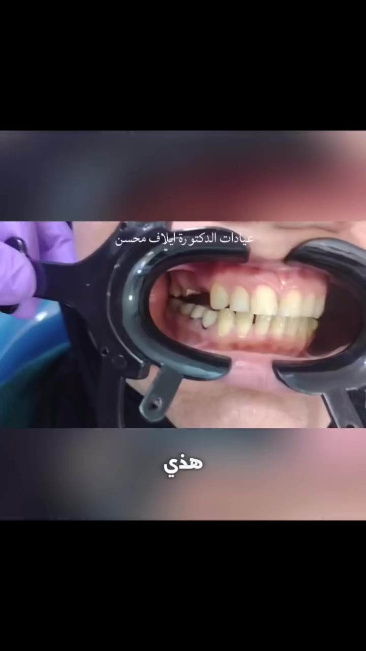 ✨ ابتسامتك هي أجمل تفصيلة بملامحك ✨
ضحكة مرتبة ونظيفة ترفع ثقتك وتخلي حضورك يلمع بكل مكان 🤍🦷
لأن الابتسامة الحلوة ما تحتاج فلتر… تحتاج عناية صح 👌

📞 للحجز والاستفسار: ***********
