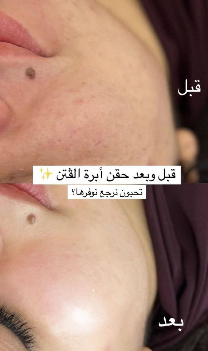 يوجد في عيادة ايفنت لطب الأسنان والتجميل
قسم التجميل لاجراحي 
يشمل 
الفلر
البوتكس 
ابر نظارة 
محفزات كولاجين  إبرة الكالسيوم وغيرها
البلازما والخلايا الجذعية للوجه والشعر 
التغير الشامل
مع نتائج مضمونة

*********** للتواصل بخصوص التجميل
بيجهم على الانستكرام 👇 
https://www.instagram.com/event.clinic?igsh=MTc3NG0ycTdxMjhxYw==
